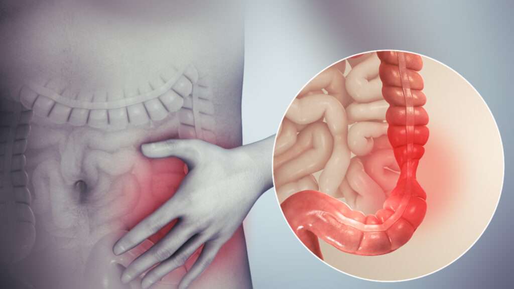 IBS Irritable bowel syndrome